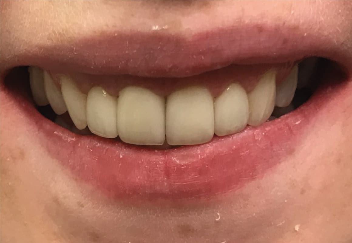 dental treatment after Invisalign