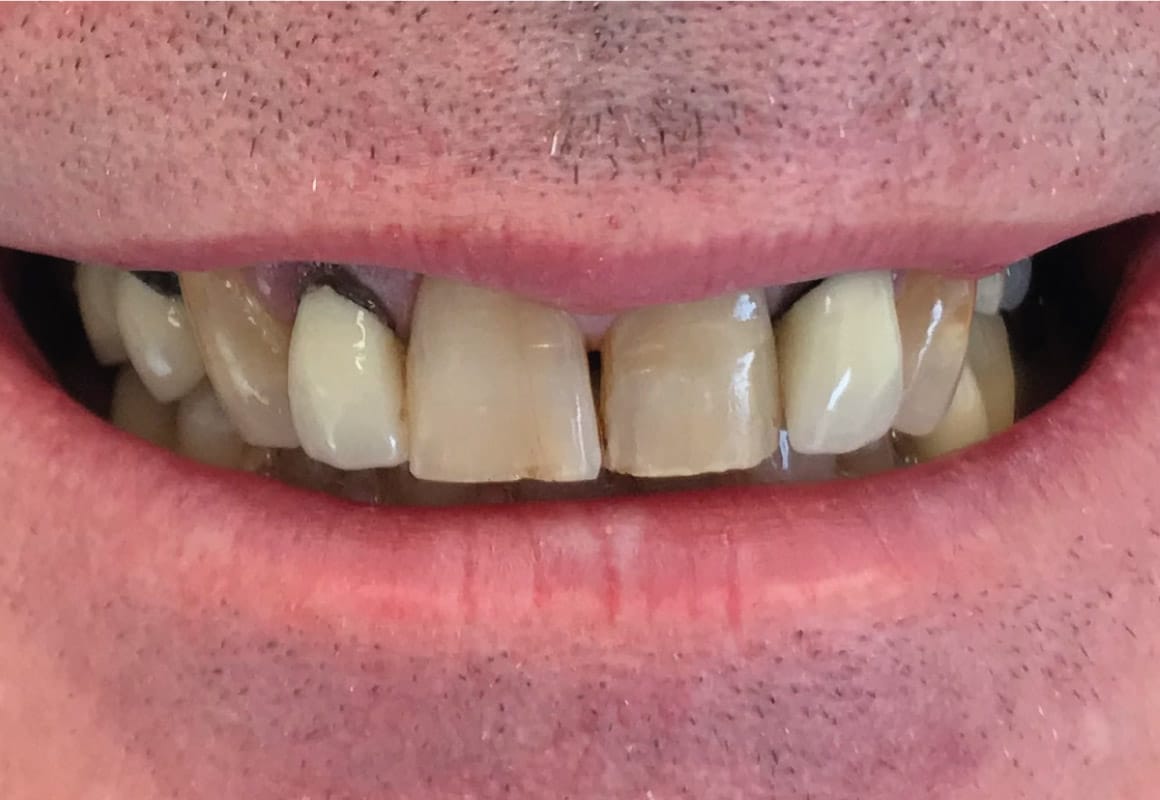 before orthodontics at vita dental spa
